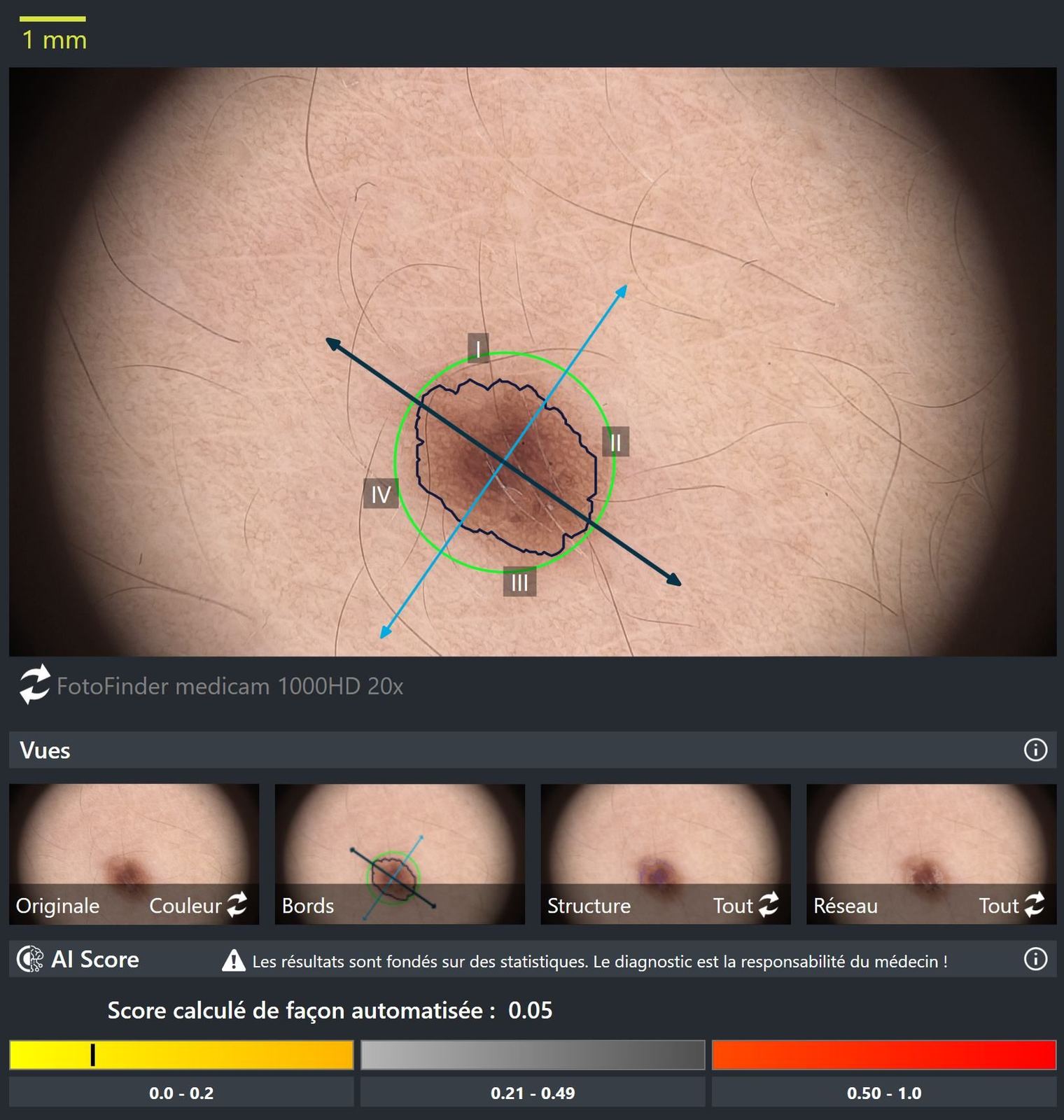 Analyse dermoscopique d'un grain de beauté par l'IA Fotofinder, avec score automatique.