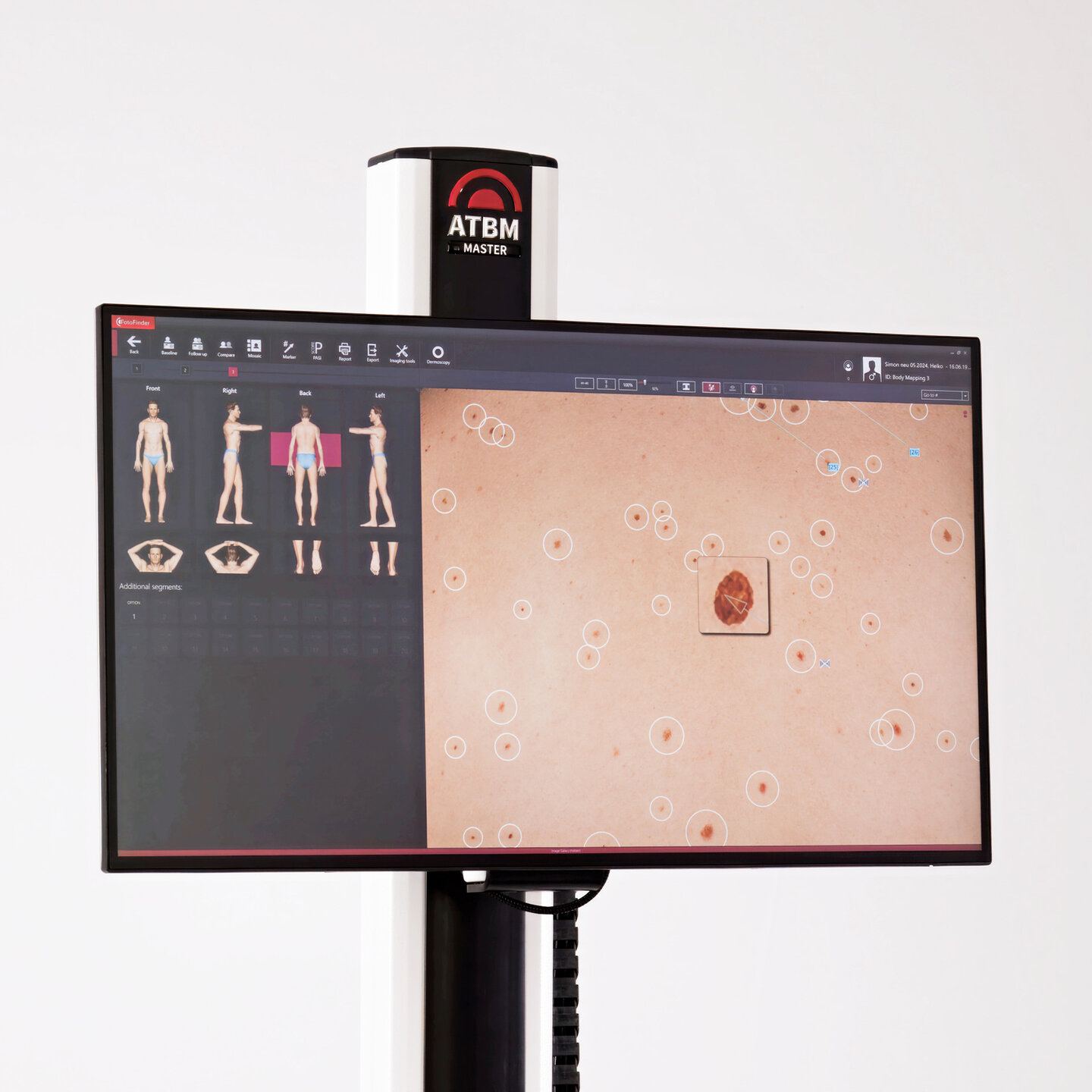 Fotofinder ATBM Master : écran 4K montrant la cartographie corporelle et une lésion analysée.