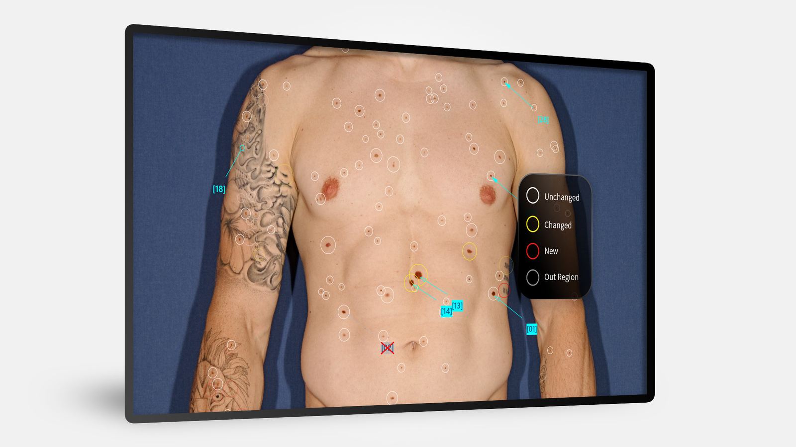 BodyScan Fotofinder : tous les grains identifiés et code-couleur (inchangé / modifié / nouveau).