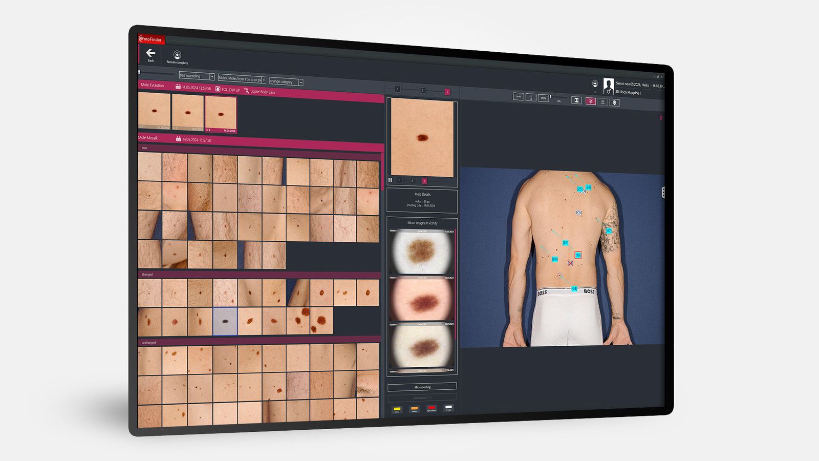 Logiciel Fotofinder Universe : vue Mosaic qui rassemble tous les grains de beauté du patient, classés Nouveaux / Modifiés / Inchangés.