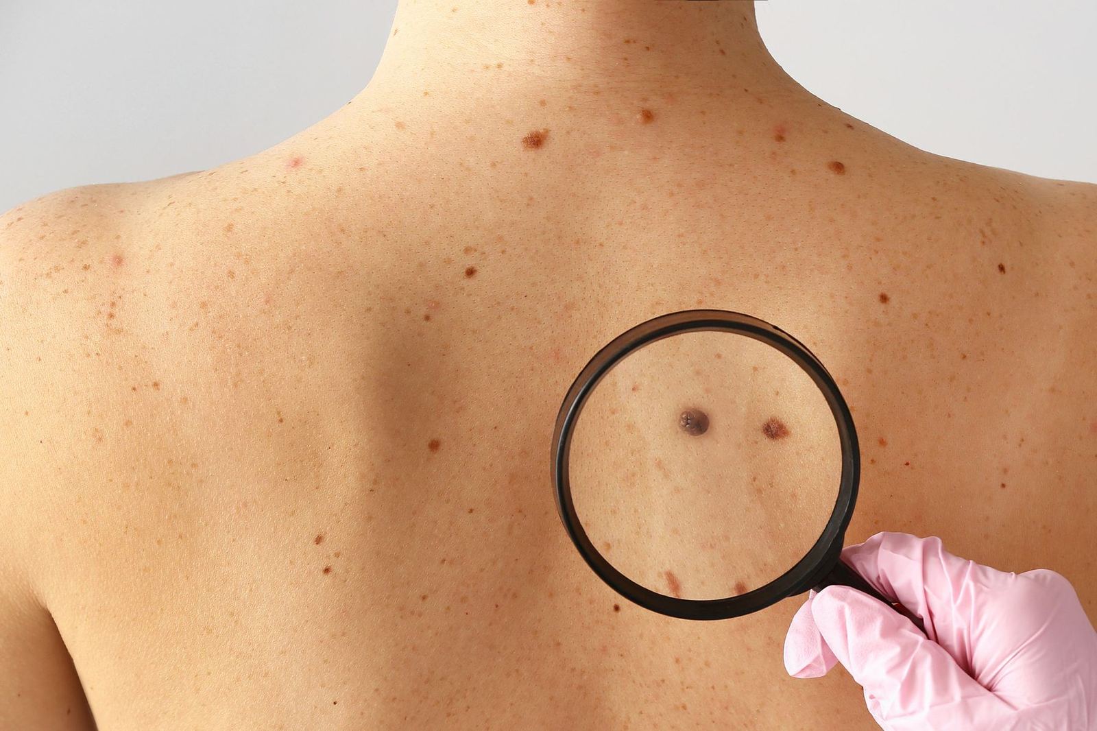 Examen à l'œil nu : un dos avec de nombreux grains de beauté observés à la loupe.