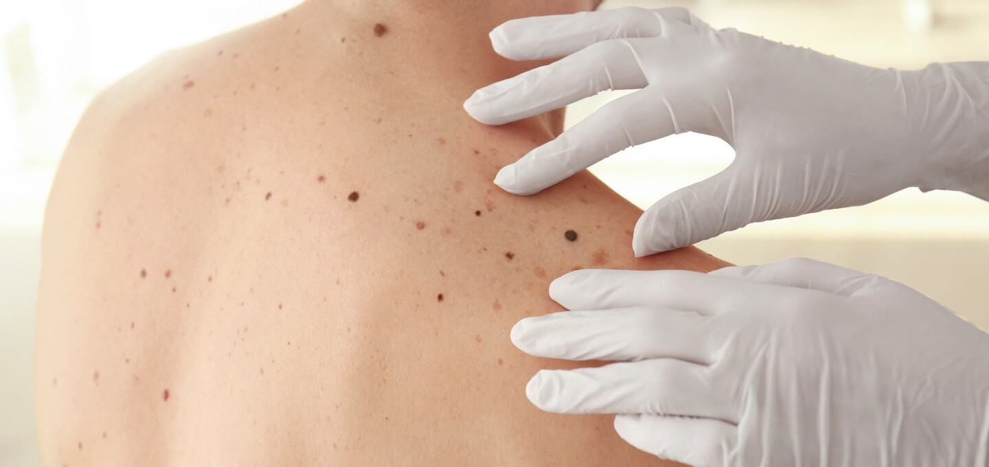 Examen clinique d'une peau avec grains de beauté.