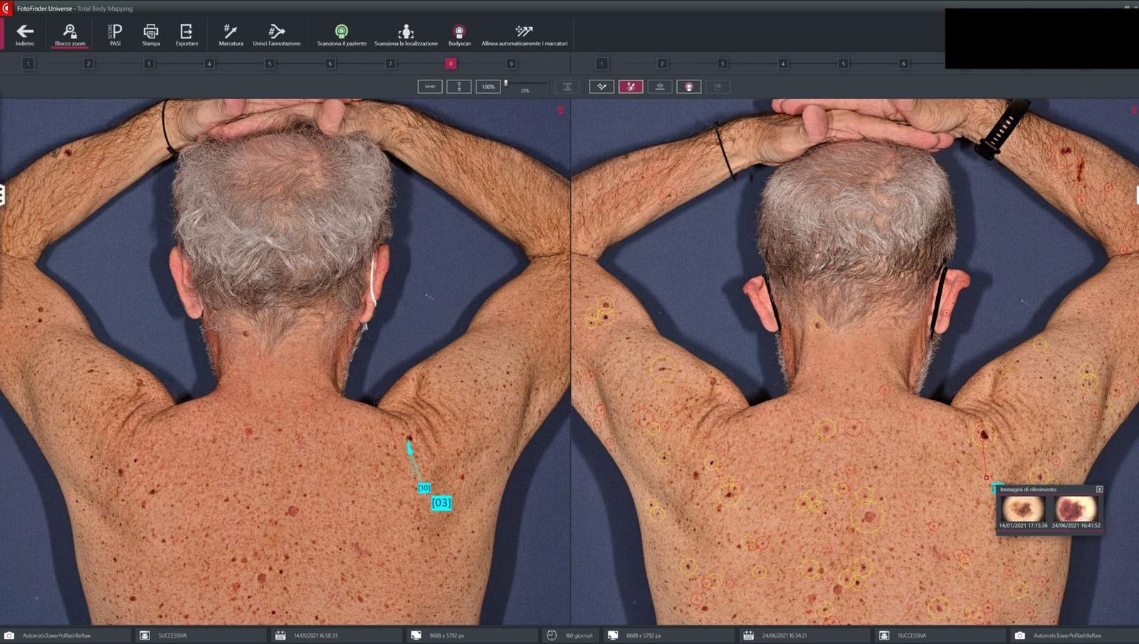 Comparaison automatique de la peau à différentes dates dans le logiciel Fotofinder Universe.